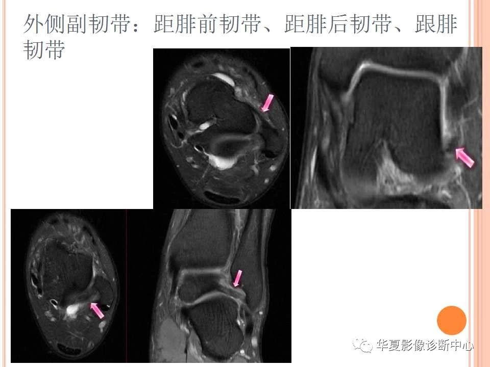 一文详解：踝关节MRI解剖及常见损伤类型