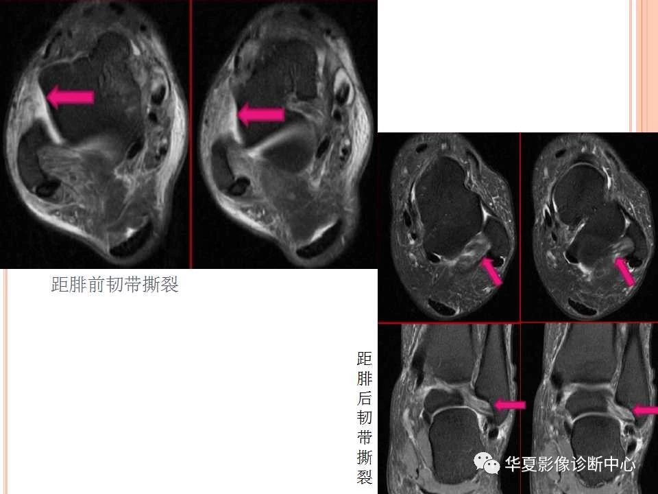 一文详解：踝关节MRI解剖及常见损伤类型