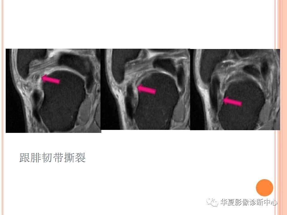 一文详解：踝关节MRI解剖及常见损伤类型