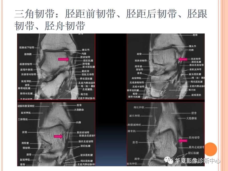 一文详解：踝关节MRI解剖及常见损伤类型