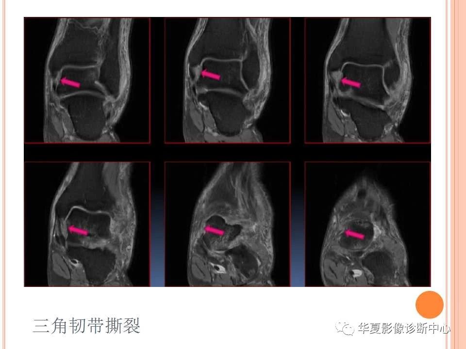 一文详解：踝关节MRI解剖及常见损伤类型