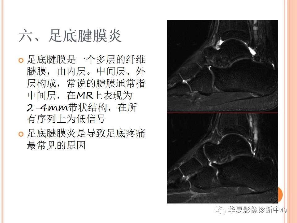 一文详解：踝关节MRI解剖及常见损伤类型