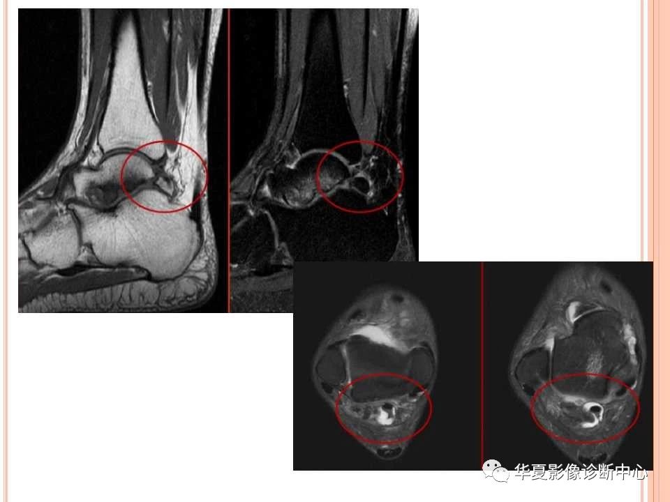一文详解：踝关节MRI解剖及常见损伤类型
