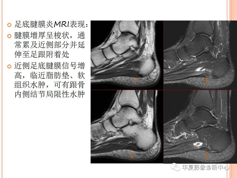 一文详解：踝关节MRI解剖及常见损伤类型