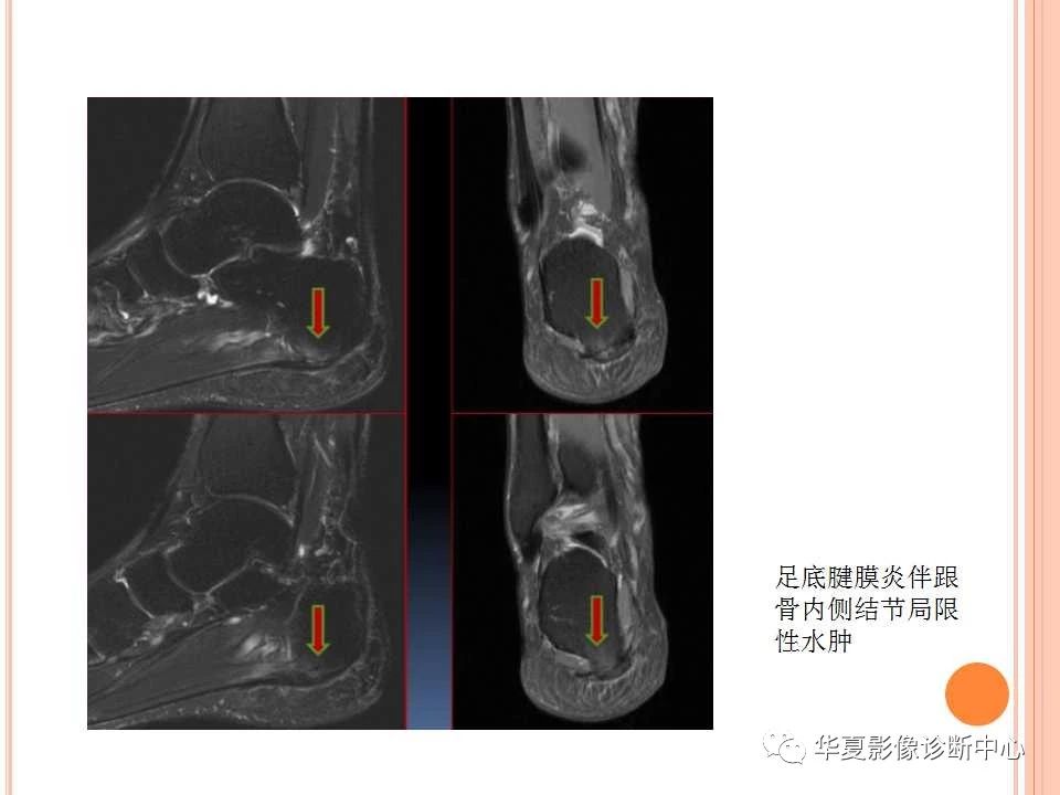 一文详解：踝关节MRI解剖及常见损伤类型