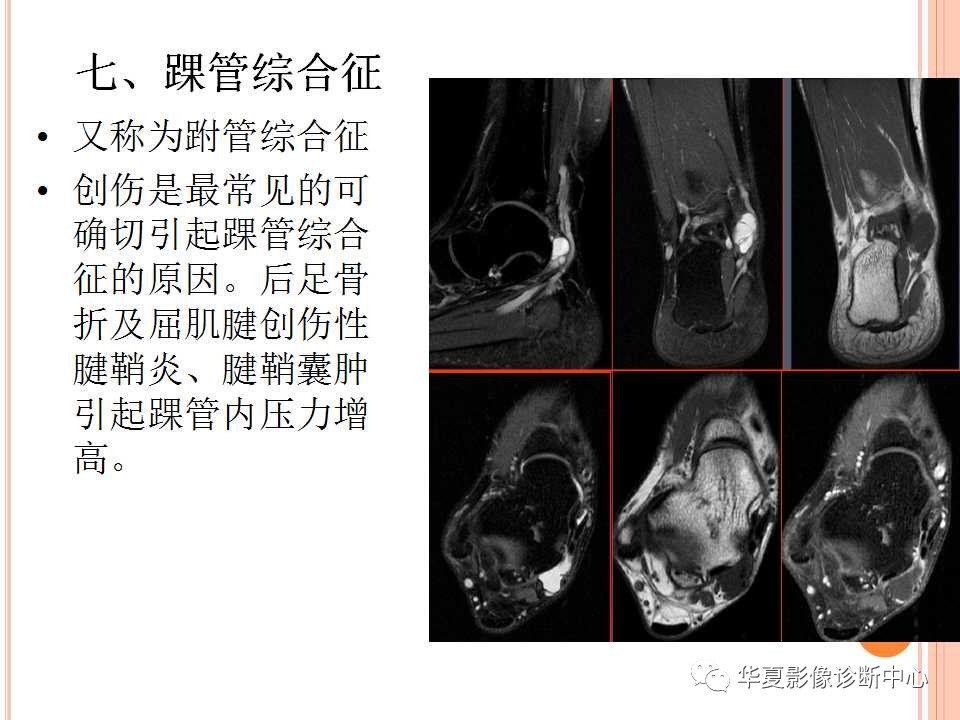 一文详解：踝关节MRI解剖及常见损伤类型