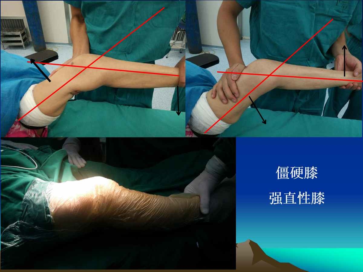 如何掌握人工膝关节置换的核心技术？看这篇！