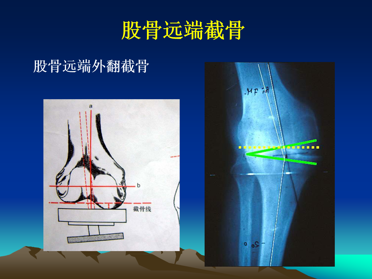 如何掌握人工膝关节置换的核心技术？看这篇！