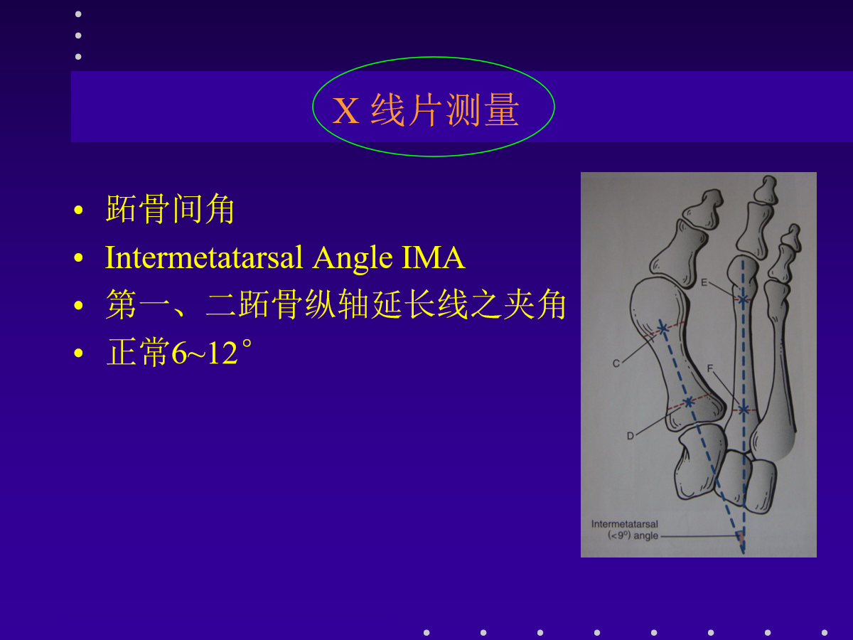 拇外翻的分型及治疗策略，一文搞定！