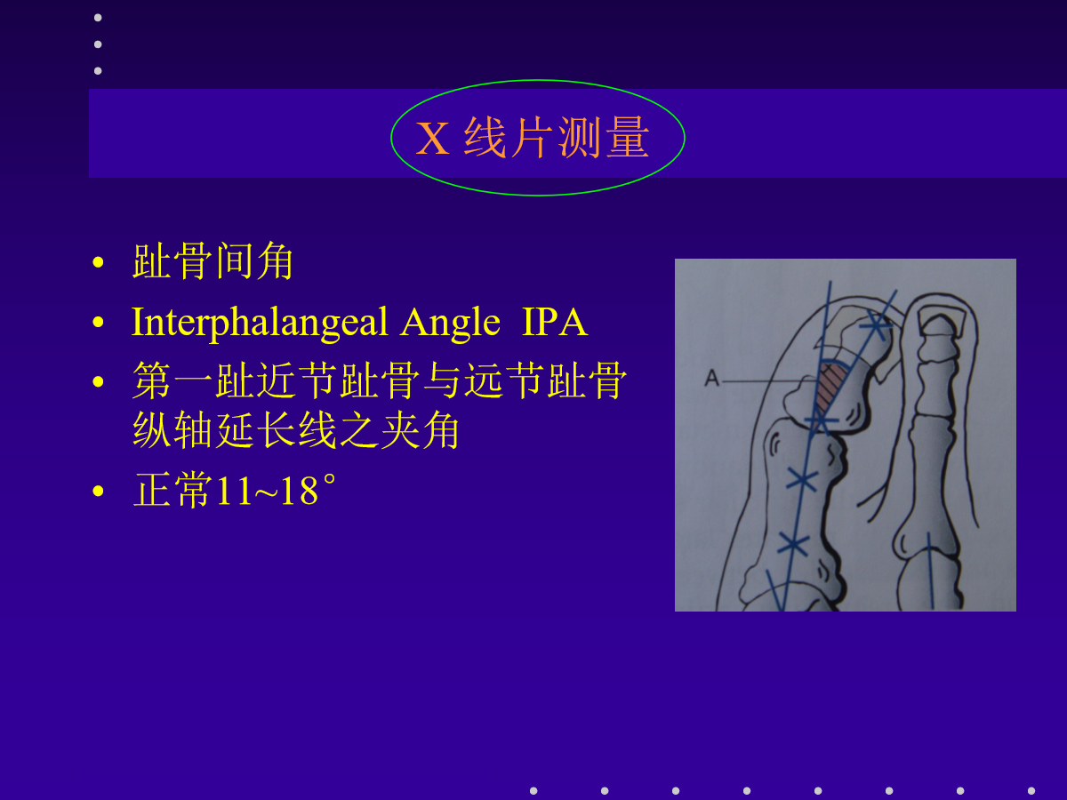 拇外翻的分型及治疗策略，一文搞定！