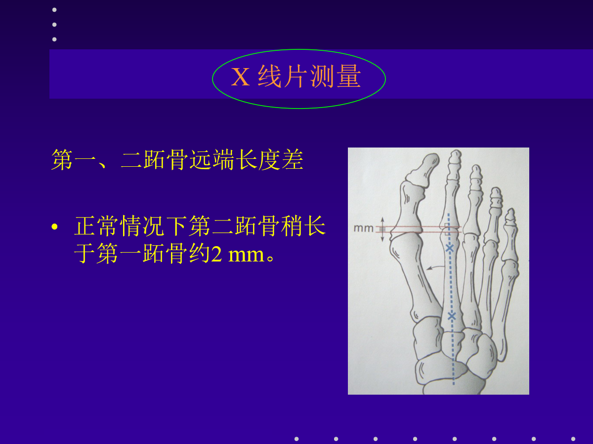 拇外翻的分型及治疗策略，一文搞定！