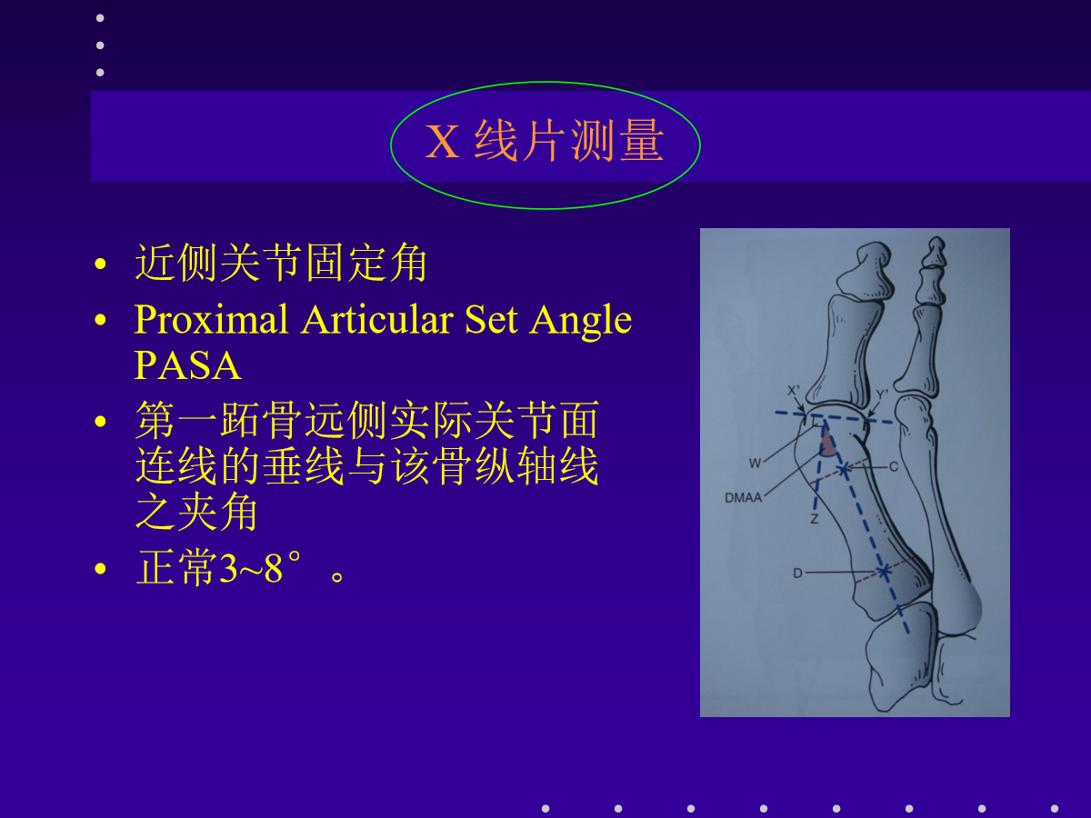 拇外翻的分型及治疗策略，一文搞定！