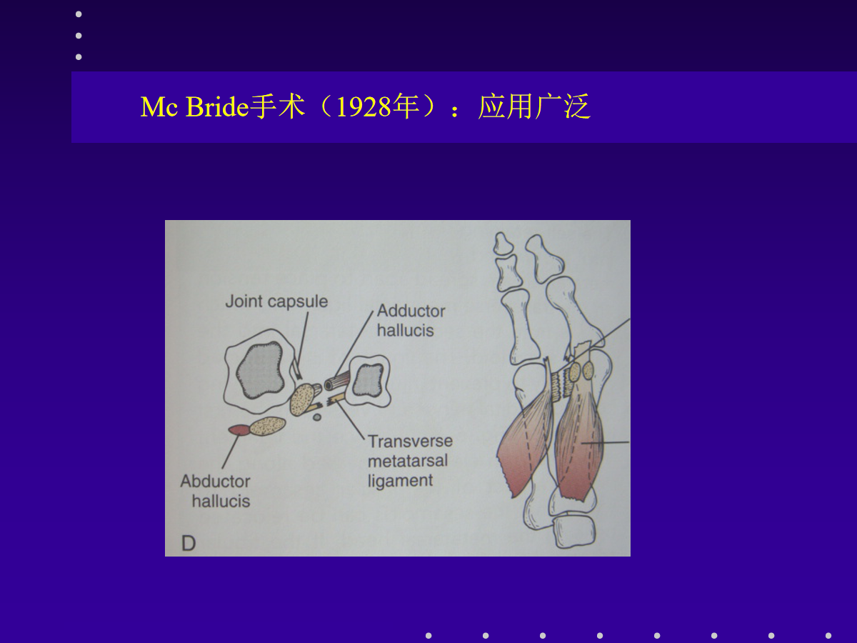 拇外翻的分型及治疗策略，一文搞定！