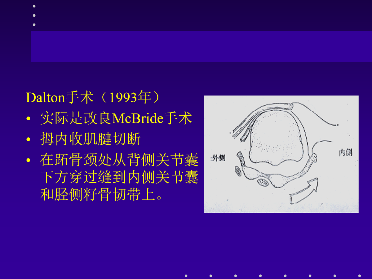 拇外翻的分型及治疗策略，一文搞定！