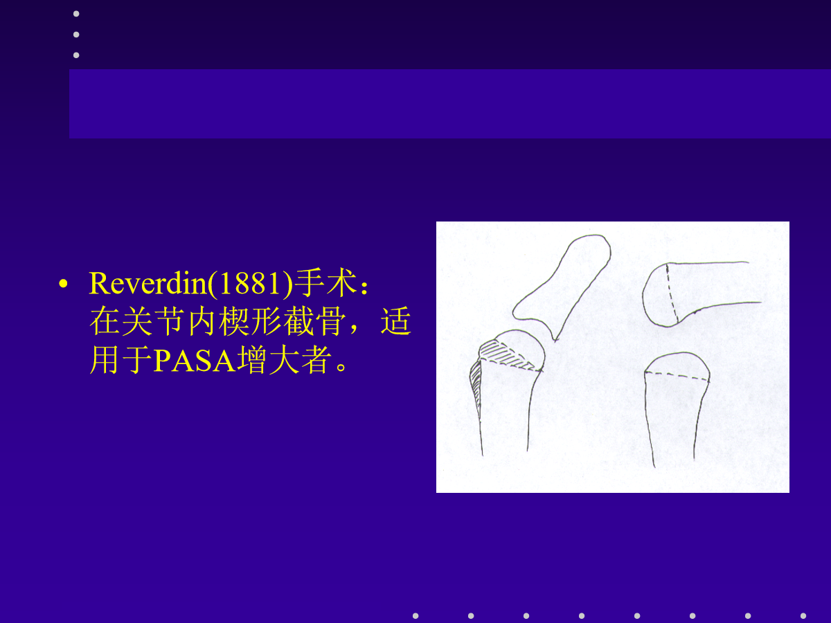 拇外翻的分型及治疗策略，一文搞定！