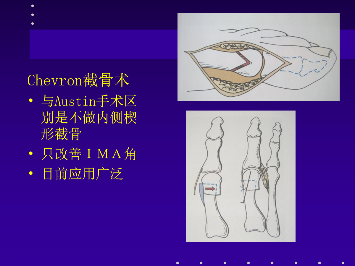 拇外翻的分型及治疗策略，一文搞定！