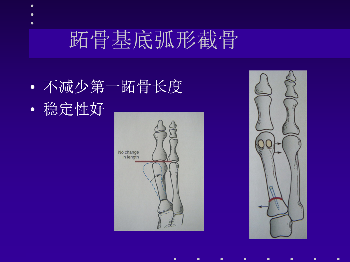 拇外翻的分型及治疗策略，一文搞定！