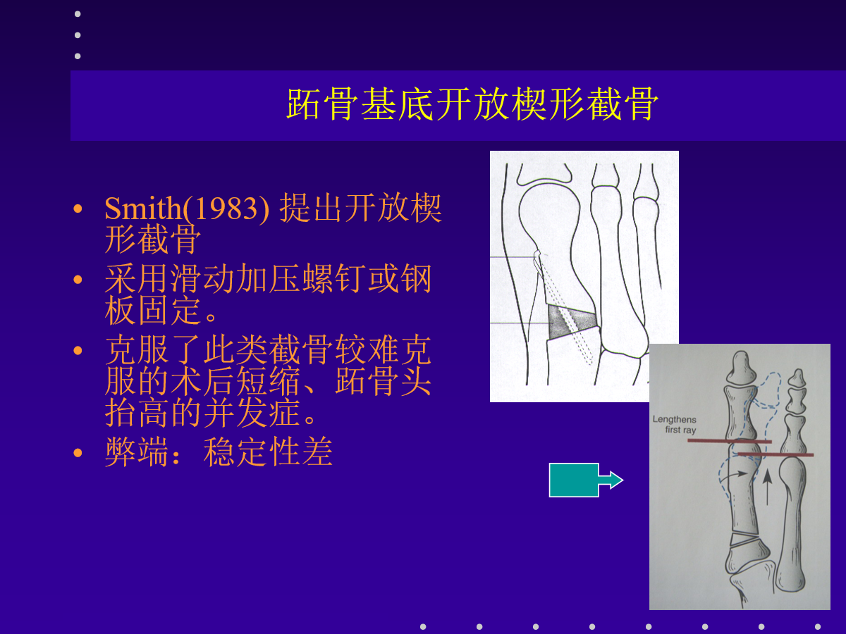 拇外翻的分型及治疗策略，一文搞定！