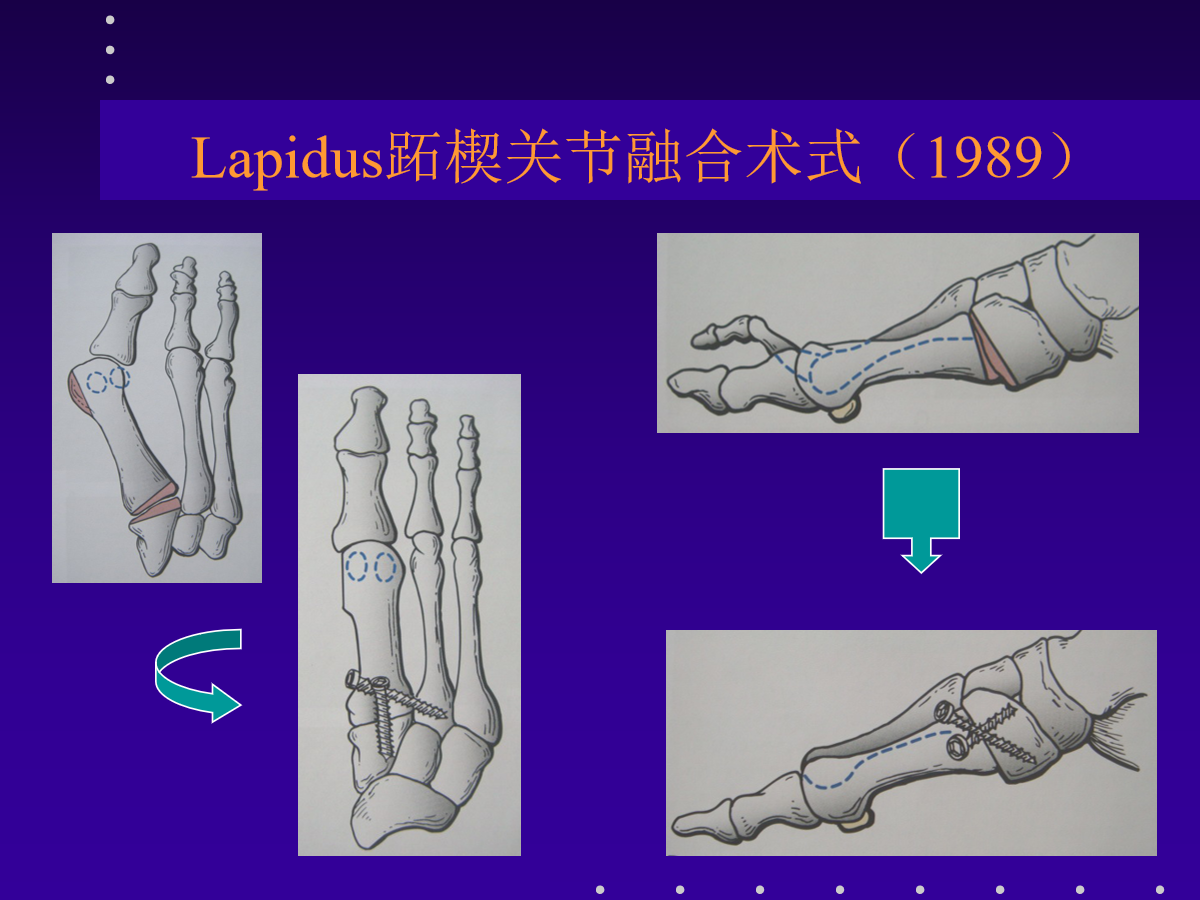 拇外翻的分型及治疗策略，一文搞定！