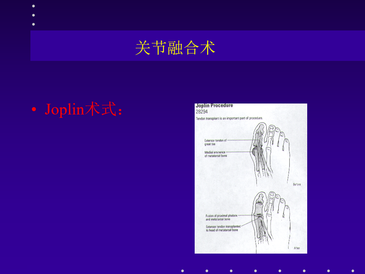 拇外翻的分型及治疗策略，一文搞定！