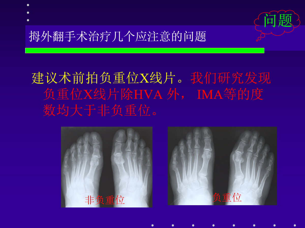 拇外翻的分型及治疗策略，一文搞定！