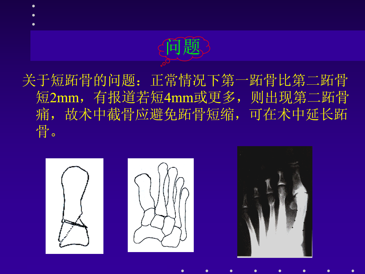 拇外翻的分型及治疗策略，一文搞定！