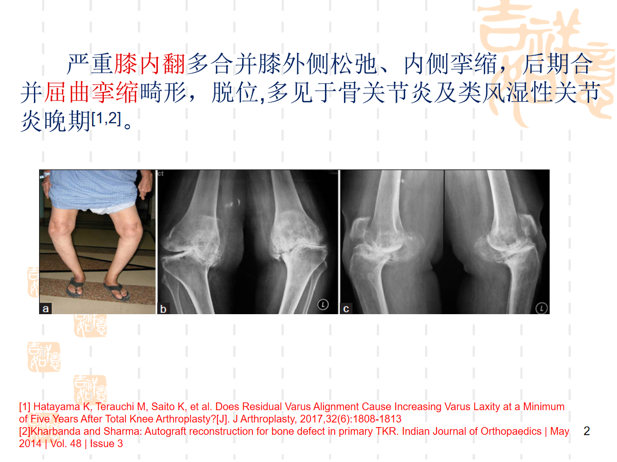 复杂初次全膝关节置换，遇到了该怎么办？