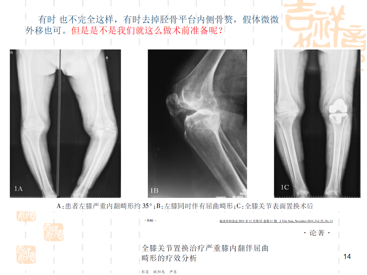 复杂初次全膝关节置换，遇到了该怎么办？