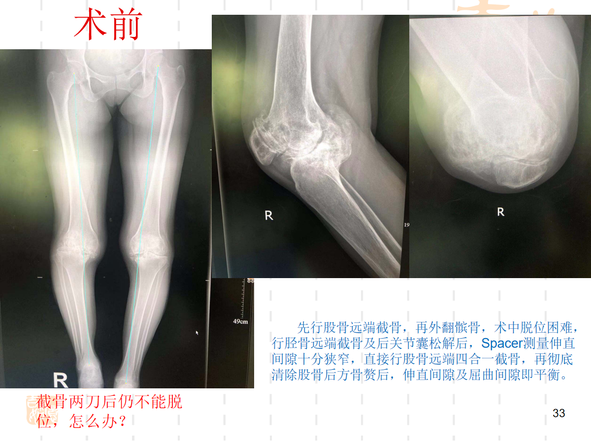 复杂初次全膝关节置换，遇到了该怎么办？