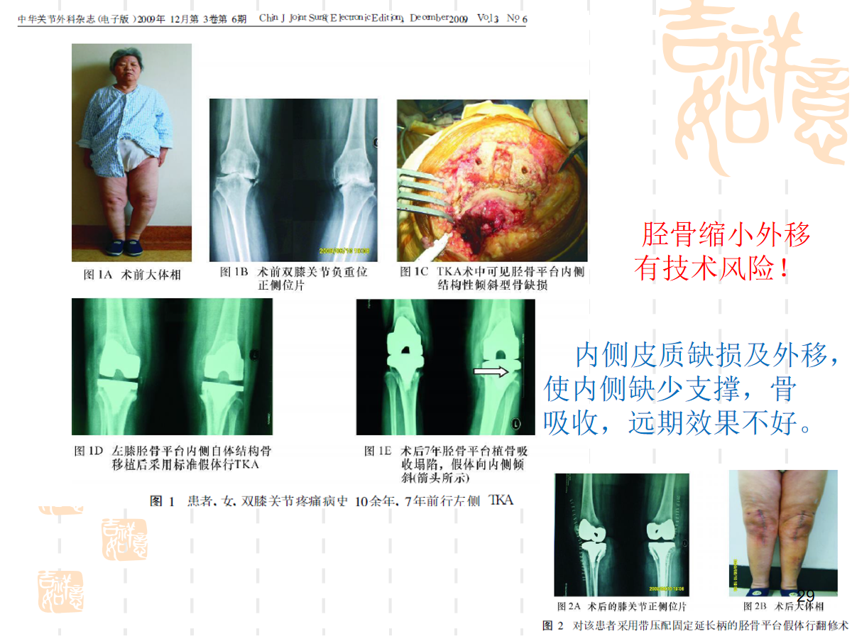 复杂初次全膝关节置换，遇到了该怎么办？