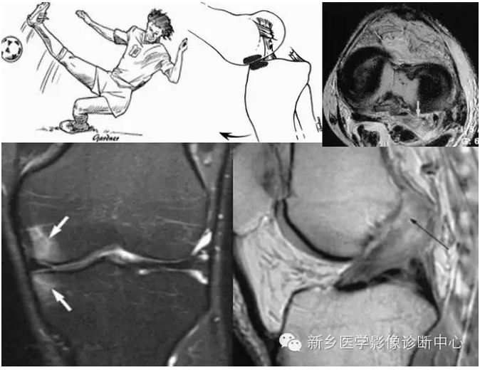 一文详解：后交叉韧带损伤的分级