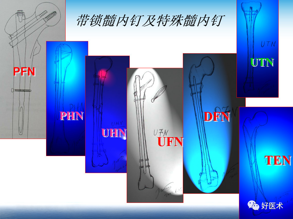 微创技术在创伤骨科中的应用，全面总结！