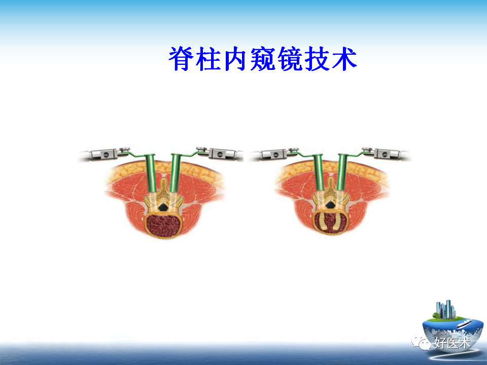 微创技术在创伤骨科中的应用，全面总结！