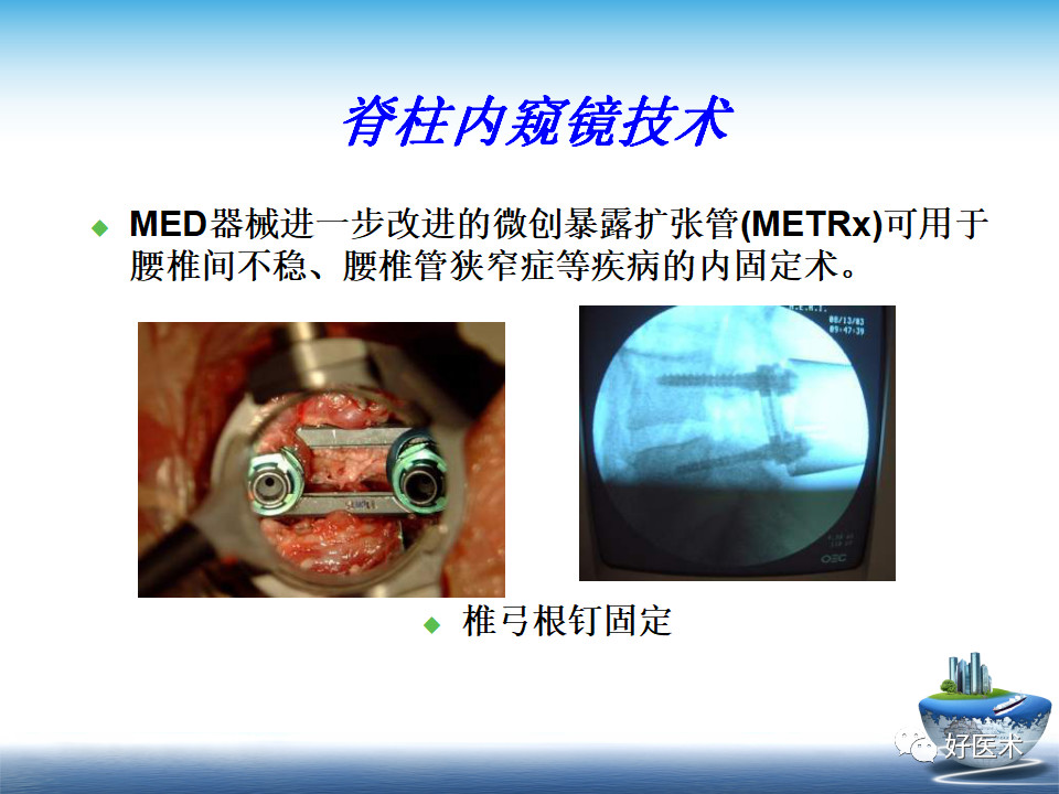 微创技术在创伤骨科中的应用，全面总结！