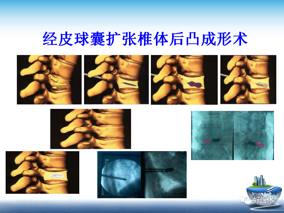 微创技术在创伤骨科中的应用，全面总结！