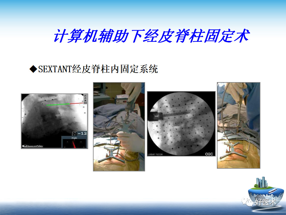 微创技术在创伤骨科中的应用，全面总结！