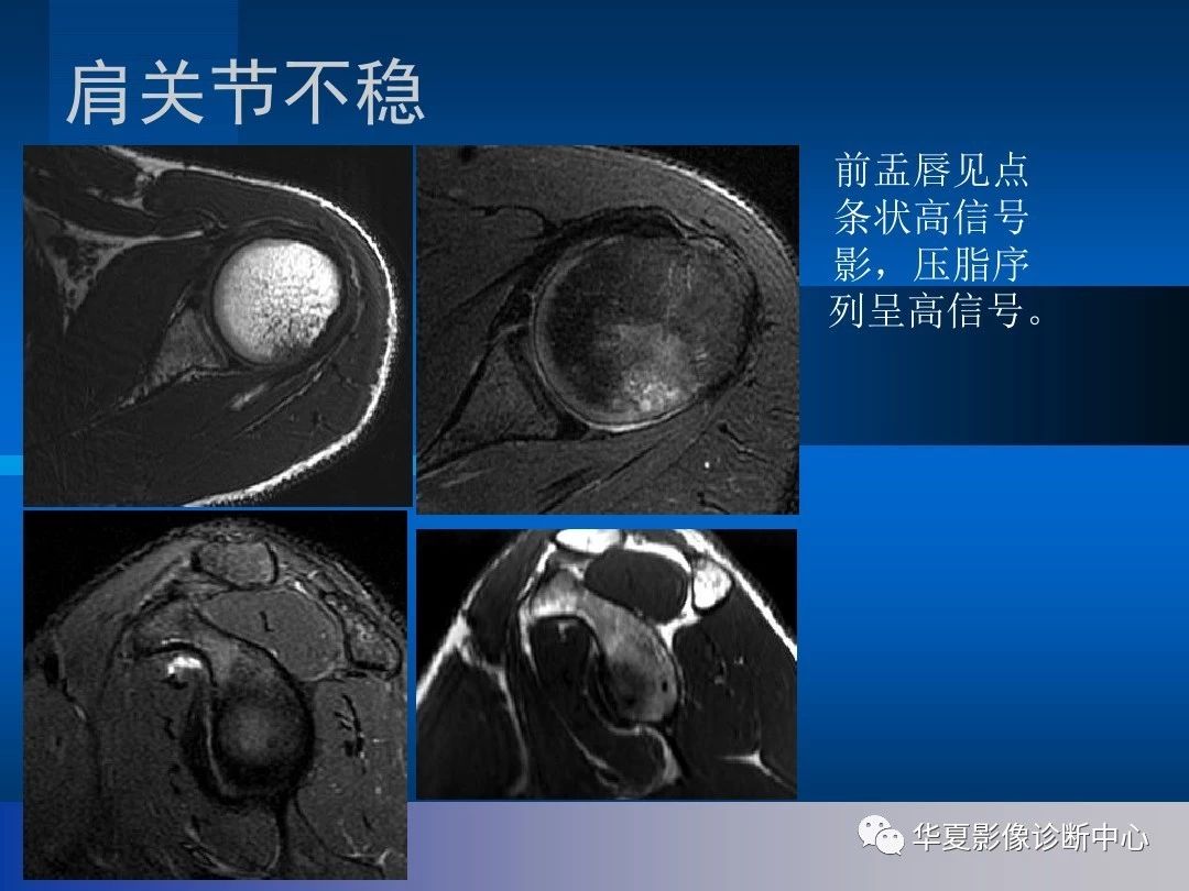 肩关节的影像解剖与MRI（附关节实物图）