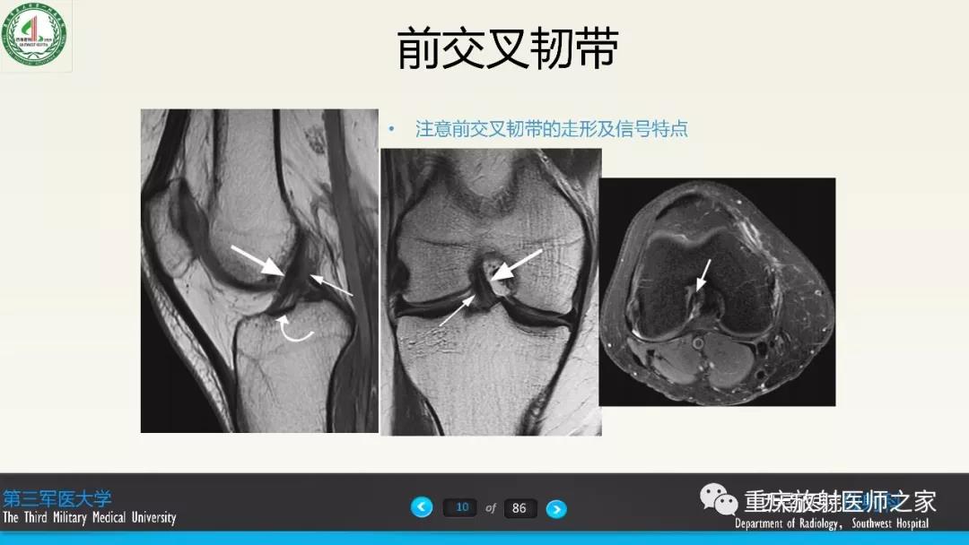 超赞，这个膝关节韧带MRI诊断课件要给满分！