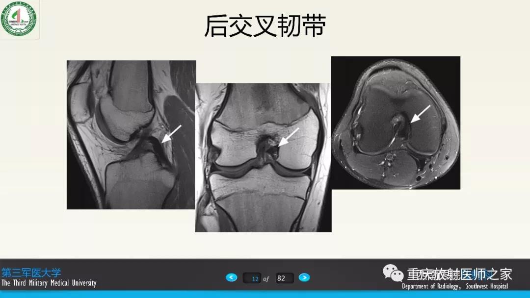 超赞，这个膝关节韧带MRI诊断课件要给满分！