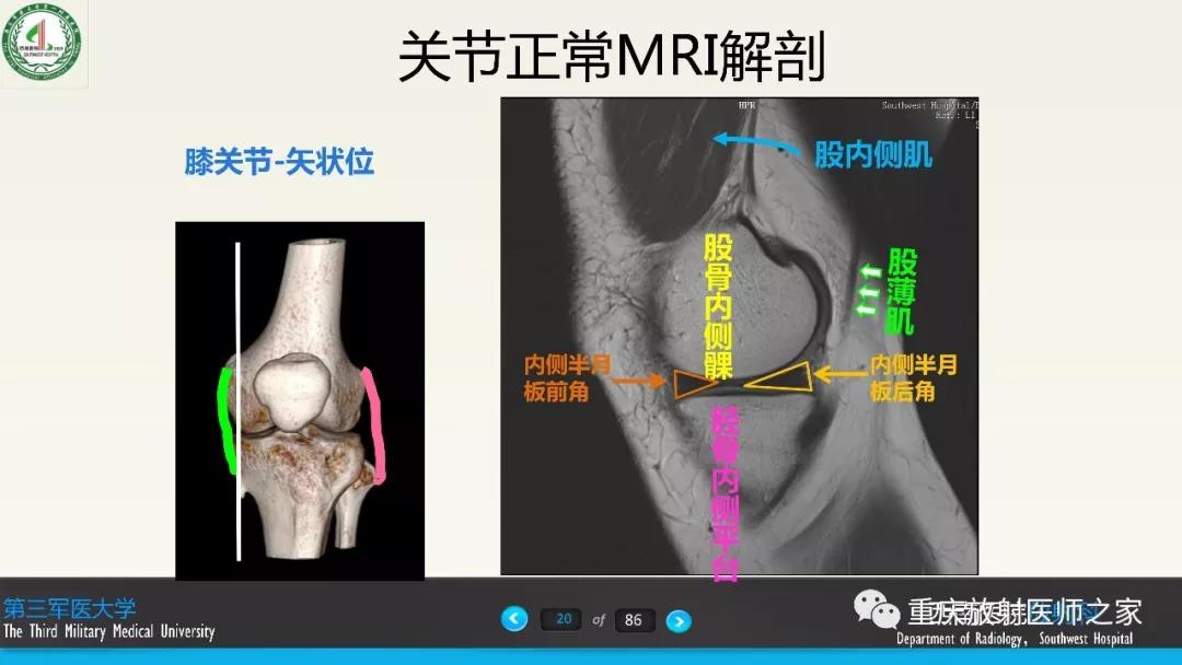 超赞，这个膝关节韧带MRI诊断课件要给满分！