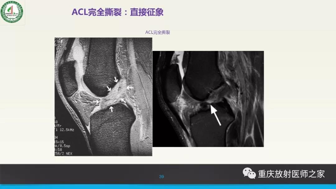 超赞，这个膝关节韧带MRI诊断课件要给满分！