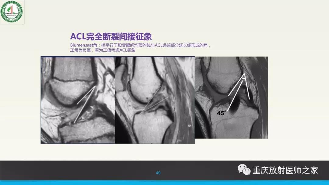 超赞，这个膝关节韧带MRI诊断课件要给满分！