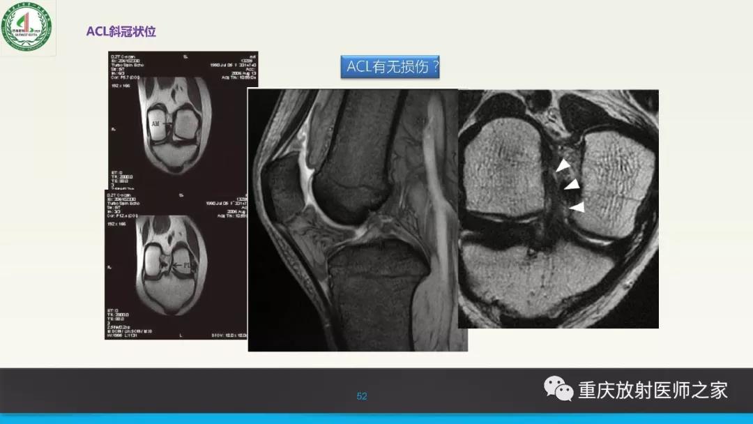 超赞，这个膝关节韧带MRI诊断课件要给满分！