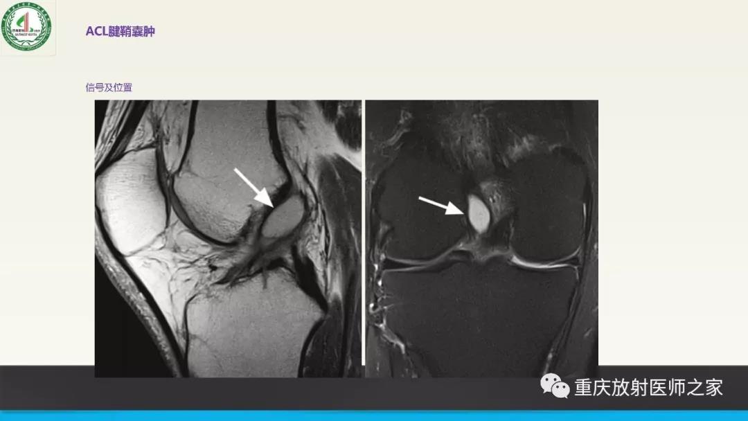 超赞，这个膝关节韧带MRI诊断课件要给满分！