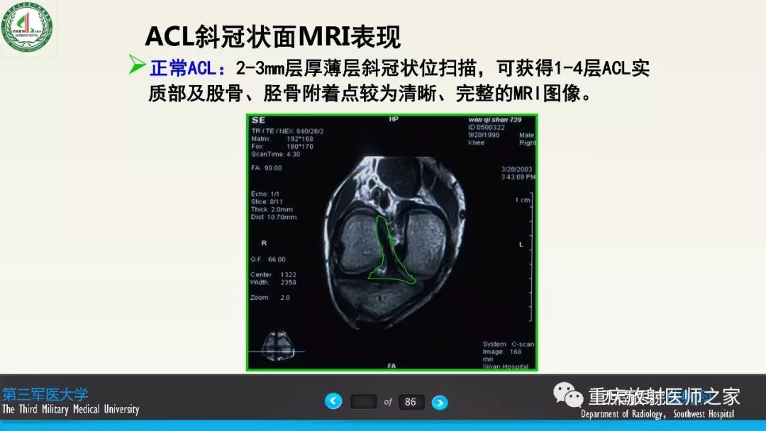 超赞，这个膝关节韧带MRI诊断课件要给满分！