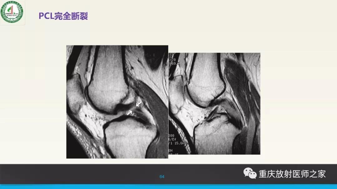 超赞，这个膝关节韧带MRI诊断课件要给满分！