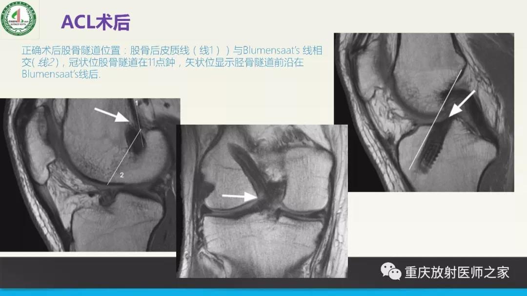 超赞，这个膝关节韧带MRI诊断课件要给满分！