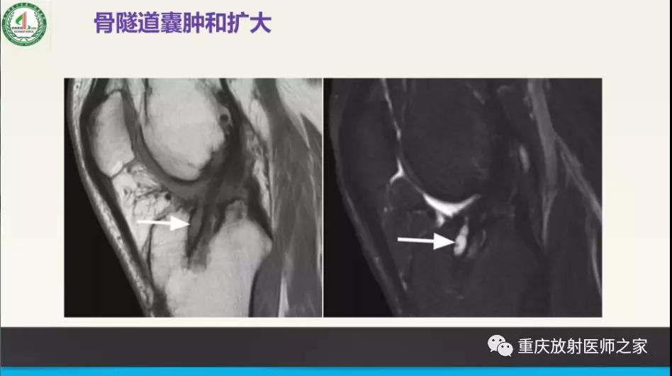 超赞，这个膝关节韧带MRI诊断课件要给满分！