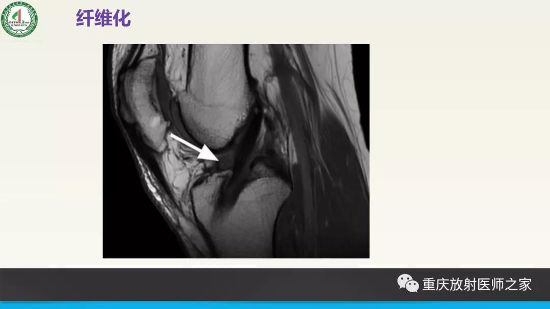 超赞，这个膝关节韧带MRI诊断课件要给满分！