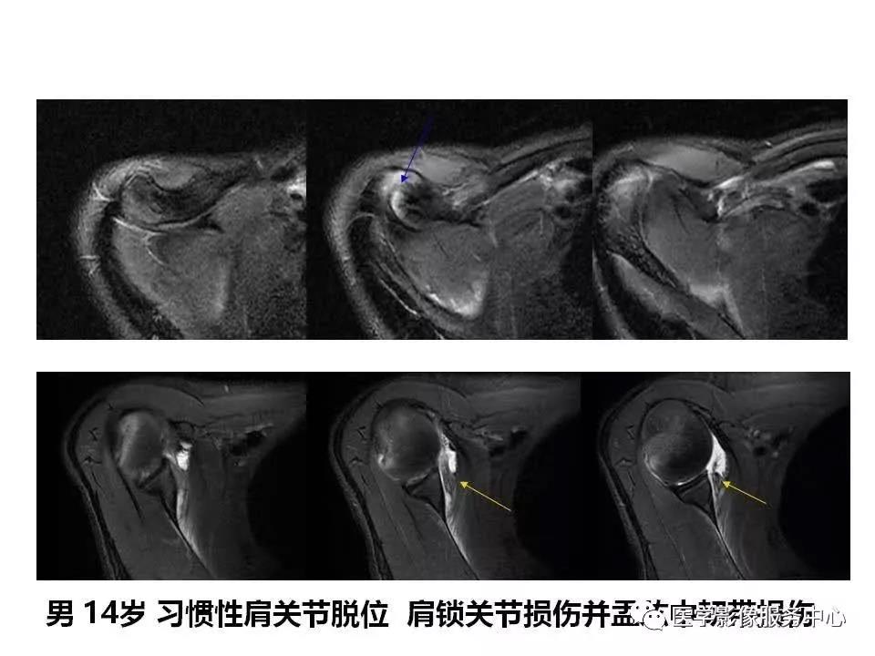 肩关节韧带及损伤的MR表现，都在这里了！